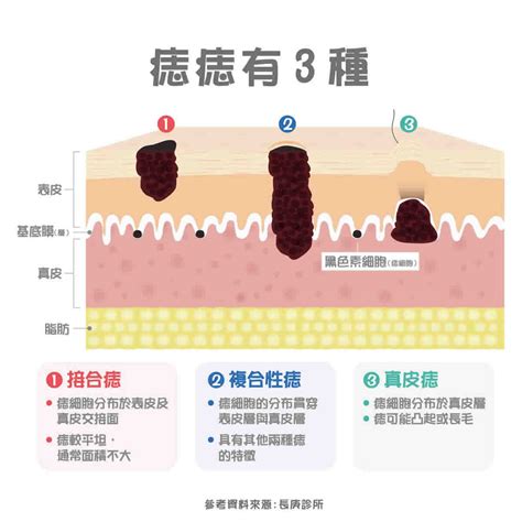 痣長白毛|痣變大、痣多或長毛會變皮膚癌？認識痣的形成與原因